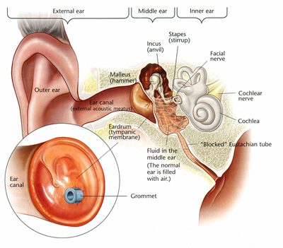  recurrent ear infections. Instructions for Surgery for BSM and Grommets